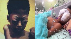 Kondisi Farel Bocah 11 Tahun Penderita Tumor Mata Semakin Lemah