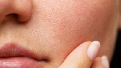 6 How to Shrink Too Large Facial Pores Naturally