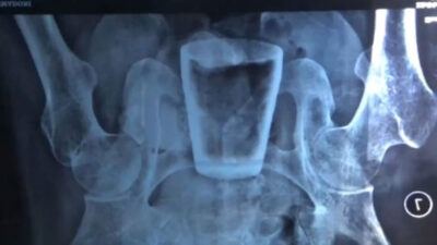 Strange but True, Exist “Glass cup” in the Belly of Jember Youth