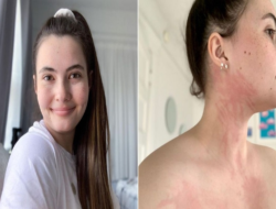 This Woman is Allergic to Water, Every Shower and Drink Even Hurts
