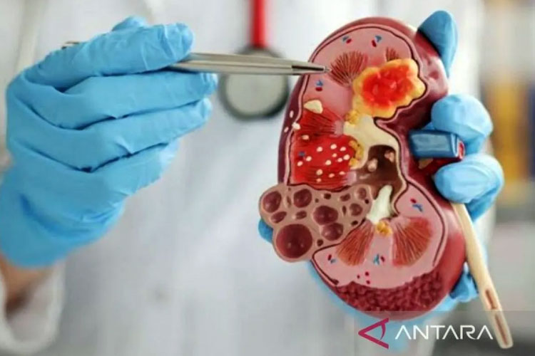 waspada!-penderita-diabetes-dan-hipertensi-rentan-gagal-ginjal-–-times-banyuwangi