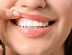 5 Tips Memutihkan Gigi Secara Aman dan Alami – TIMES Banyuwangi