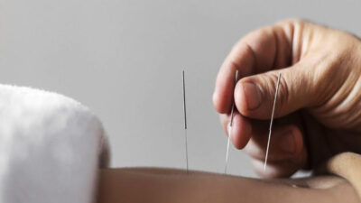 akupunktur-estetika-wajah,-opsi-medis-untuk-kulit-lebih-cerah-–-times-banyuwangi