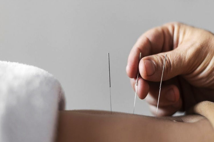 akupunktur-estetika-wajah,-opsi-medis-untuk-kulit-lebih-cerah-–-times-banyuwangi