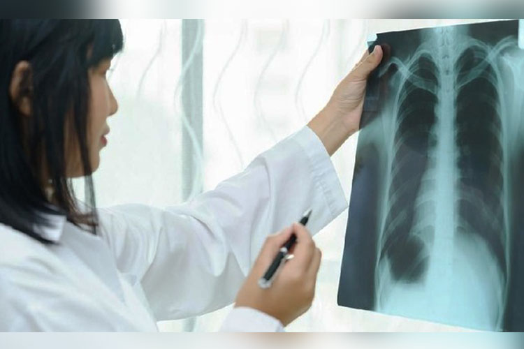 indonesia-tambah-anggaran-khusus-untuk-percepatan-deteksi-tbc-–-times-banyuwangi